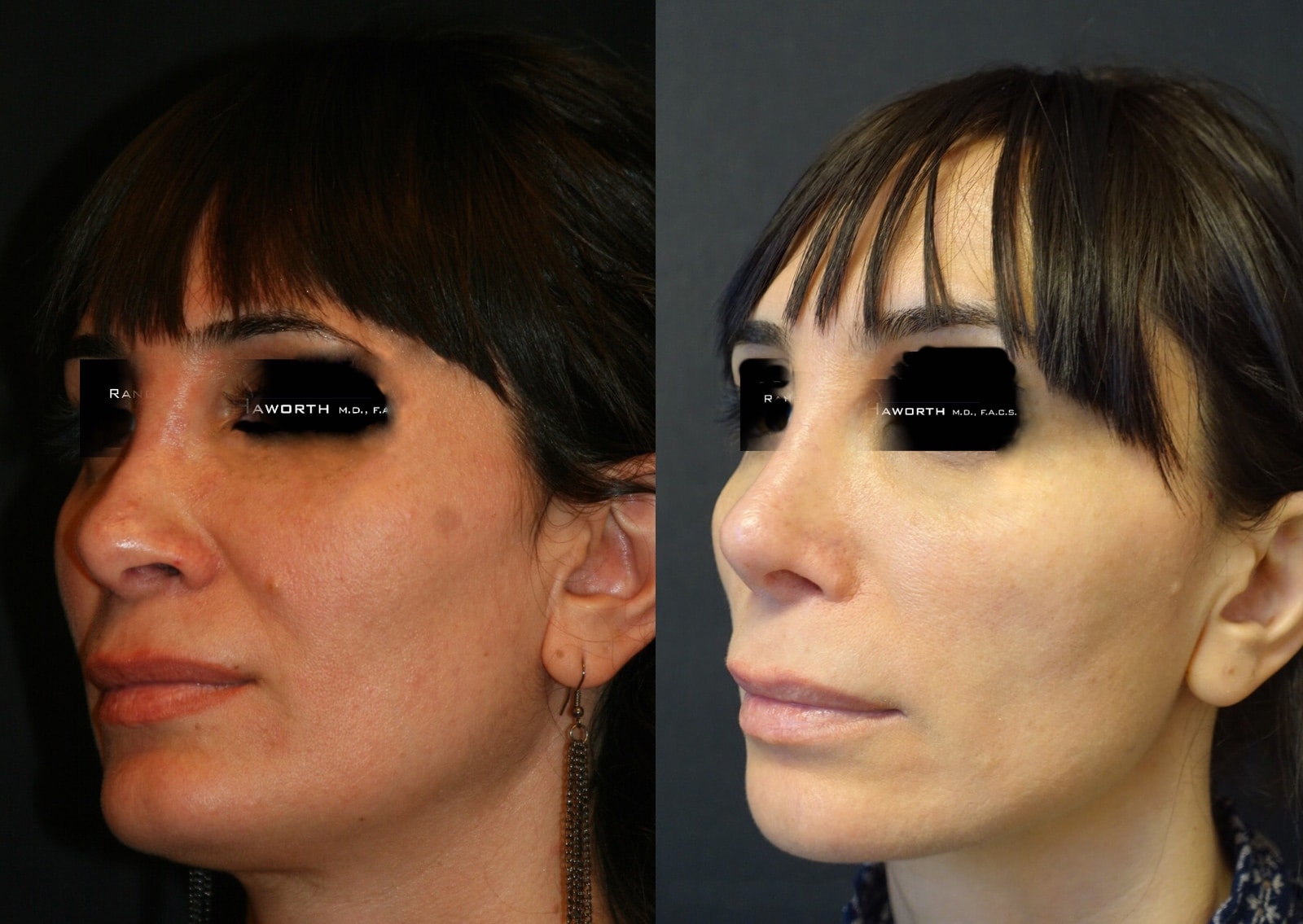 what is a closed rhinoplasty
